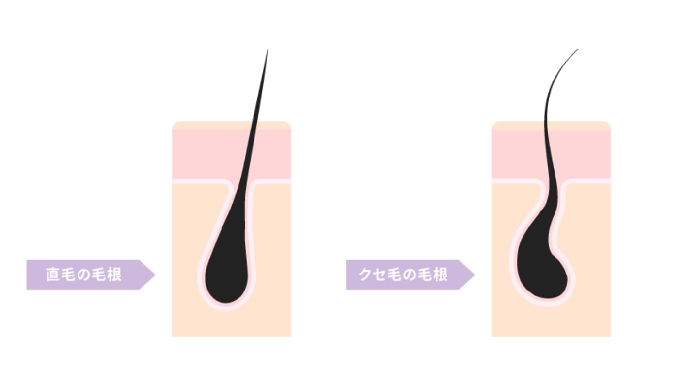 毛穴の形状が歪んでいる