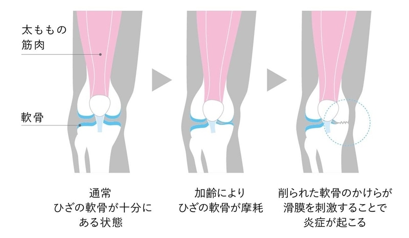 膝が痛い原因