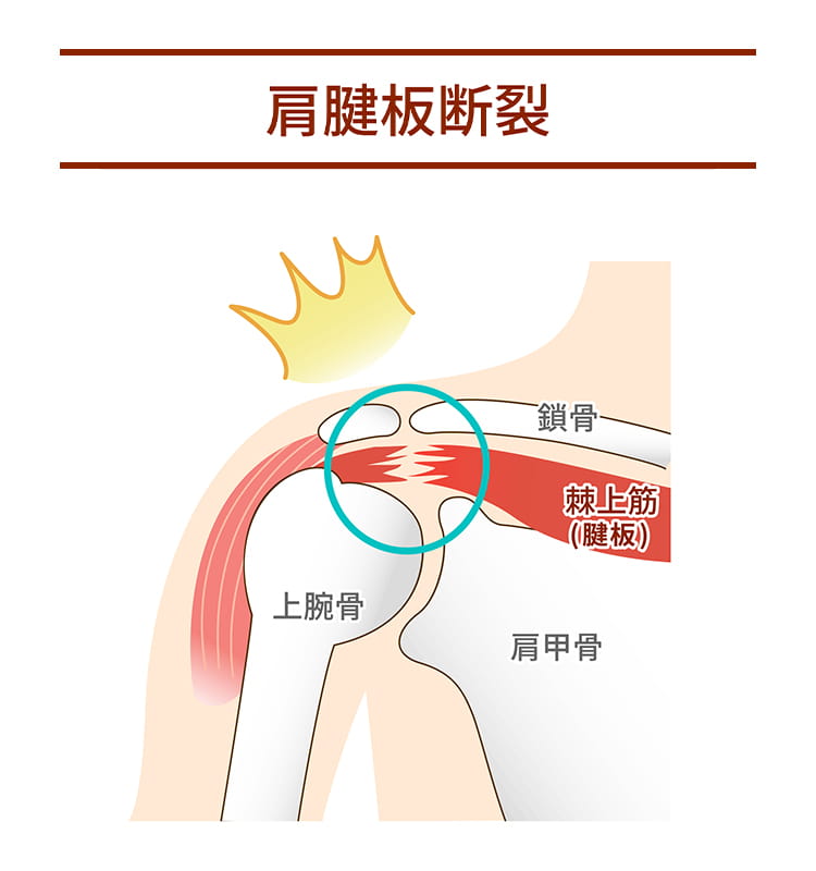 肩腱板断裂